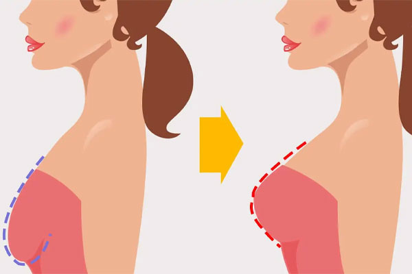 لیفت سینه بدون جراحی