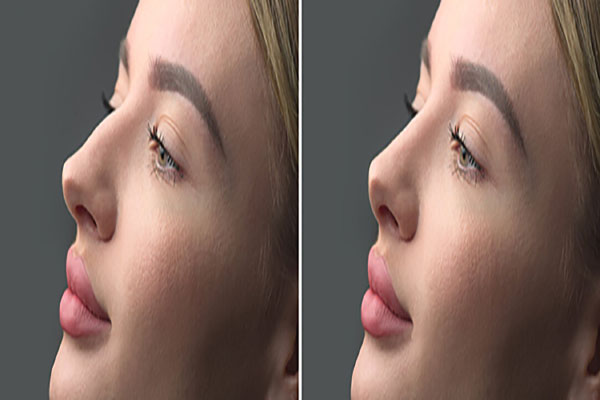 چرا بینی گوشتی نیازمند جراحی تخصصی ‌تری است؟